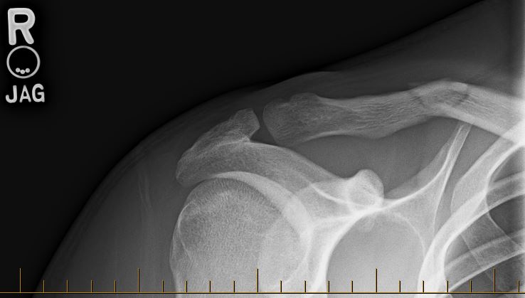 Clavicule