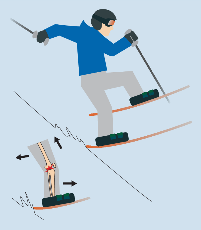 Activités de sports d'hiver à Kniegelenk | L'orthopédie